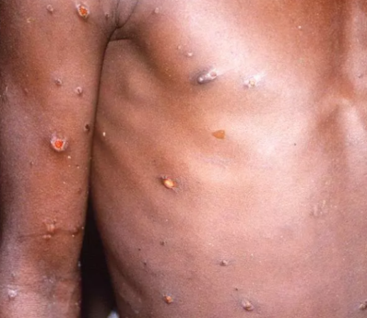 Alerta en España y Portugal por la viruela del mono: cinco casos confirmados y más de 40 sospechosos