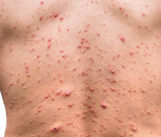 Detectaron el primer caso sospechoso de viruela del mono en la Argentina.