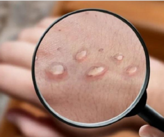 VIRUELA DEL MONO: Confirmaron el primer caso en Mendoza y es el cuarto en todo el país.