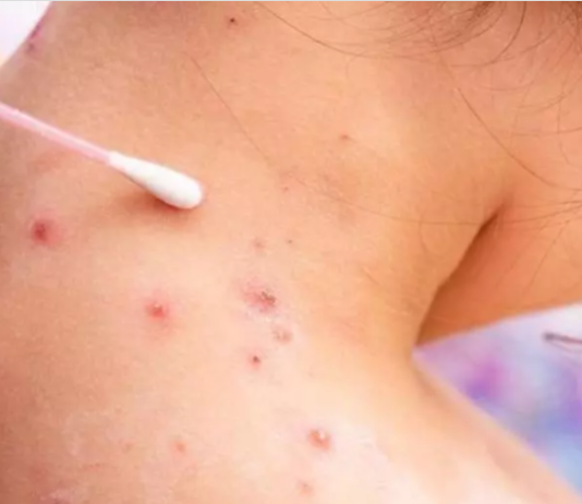 Alarma por la Viruela del Mono: en una semana se triplicaron los casos a nivel mundial