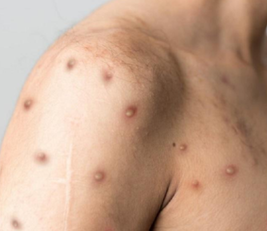 VIRUELA DEL MONO: Ya suman 24 los casos confirmados en el país.