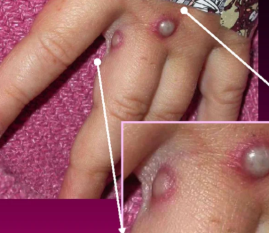 Ya son 32 los casos de viruela del mono en la Argentina: cuáles son los síntomas más frecuentes