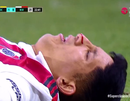 SUPERCLÁSICO: Aliendro fue operado de su grave lesión: microplacas de titanio, tornillos y visita de Gallardo en el hospital