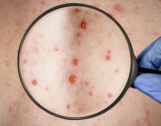 Confirmaron un caso de viruela del mono en Corrientes