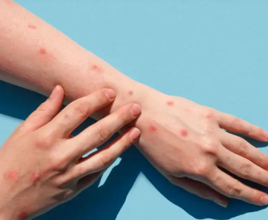 Viruela del mono: confirmaron 221 casos en la Argentina, un 30% más que la semana pasada