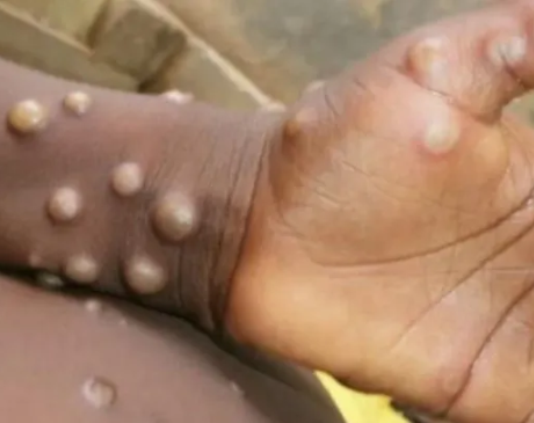 VIRUELA DEL MONO: Crecieron 20% los casos en una semana.