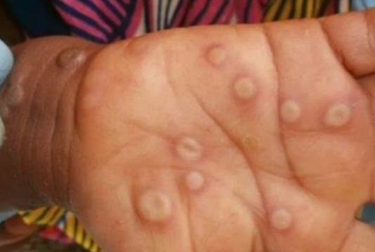 Viruela del mono en Argentina: los casos crecieron 60% en las últimas 4 semanas