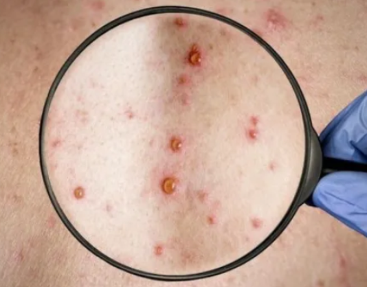 VIRUELA SÍMICA: confirman el primer caso infantil.