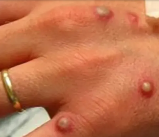 ALERTA: Confirmaron el primer caso de viruela del mono en el Chaco.