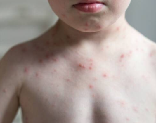 Alerta en la región por caso confirmado de Sarampión en Paraguay