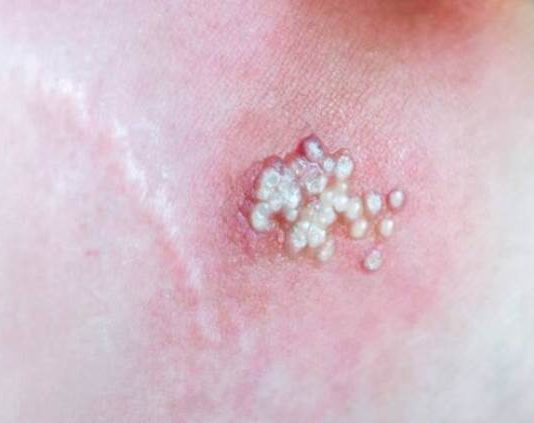 VIRUELA DEL MONO: Se confirmó la segunda muerte en Argentina