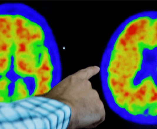 AVANCE CIENTIFICO: Nuevo tratamiento contra el Alzheimer consigue disminuir la pérdida de memoria