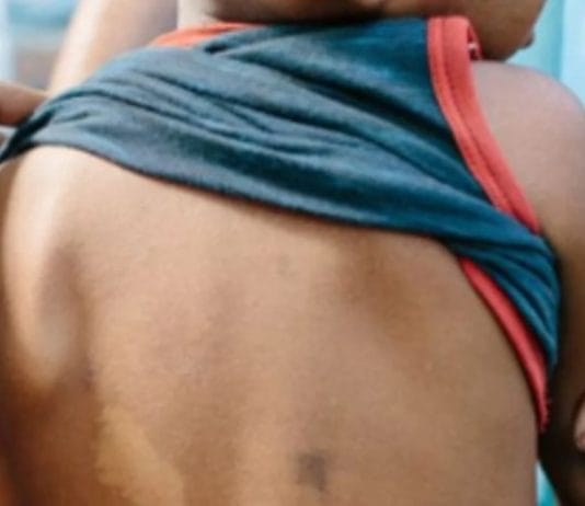 Alertan por el aumento de una enfermedad contagiosa que preocupa en todo el mundo