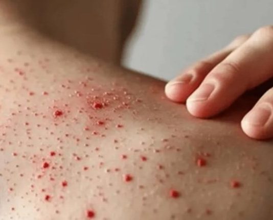 Se registraron nuevos casos de sarampión en el país: el AMBA es el más afectado