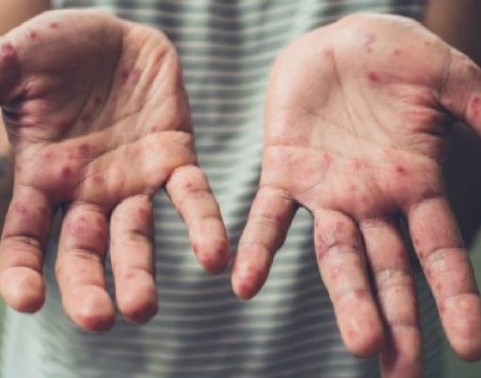 ALERTA POR SARAMPIÓN: Hay cuatro brotes activos en el país y otros 500 casos en investigación